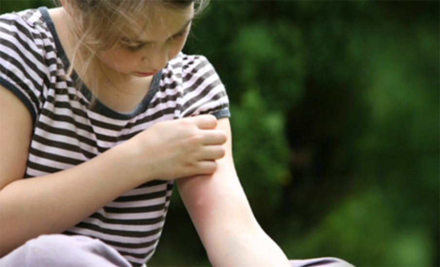 symptoms of anaphylaxis